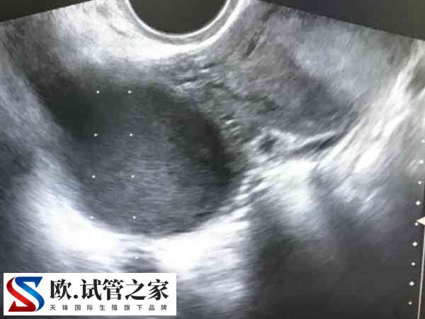 双子宫做试管婴儿有无影响(图2)